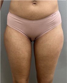 Liposuction After Photo by Franklin Richards, MD; Bethesda, MD - Case 49206