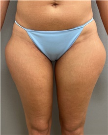 Liposuction Before Photo by Franklin Richards, MD; Bethesda, MD - Case 49206