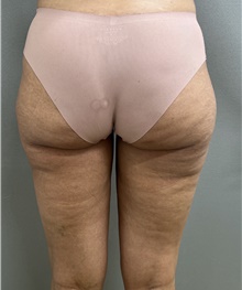 Liposuction After Photo by Franklin Richards, MD; Bethesda, MD - Case 49206