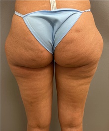 Liposuction Before Photo by Franklin Richards, MD; Bethesda, MD - Case 49206