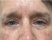 Eyelid Surgery After Photo by Franklin Richards, MD; Bethesda, MD - Case 49252