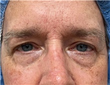 Eyelid Surgery Before Photo by Franklin Richards, MD; Bethesda, MD - Case 49252