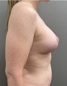 Breast Lift After Photo by Franklin Richards, MD; ,  - Case 50358