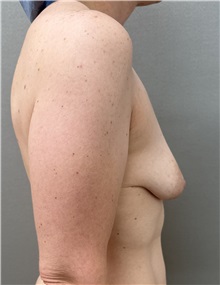 Breast Lift Before Photo by Franklin Richards, MD; ,  - Case 50358
