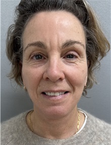 Facelift After Photo by Franklin Richards, MD; ,  - Case 50449