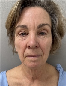 Facelift Before Photo by Franklin Richards, MD; ,  - Case 50449