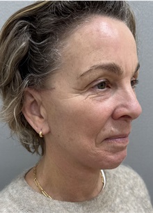 Facelift After Photo by Franklin Richards, MD; ,  - Case 50449