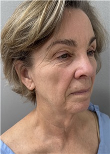 Facelift Before Photo by Franklin Richards, MD; ,  - Case 50449