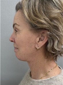 Facelift After Photo by Franklin Richards, MD; ,  - Case 50449
