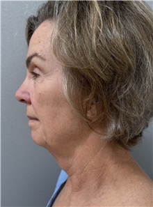 Facelift Before Photo by Franklin Richards, MD; ,  - Case 50449