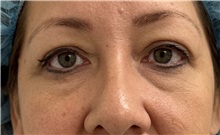 Eyelid Surgery Before Photo by Franklin Richards, MD; ,  - Case 50450