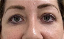 Eyelid Surgery After Photo by Franklin Richards, MD; ,  - Case 50451