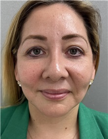 Cheek Reduction After Photo by Franklin Richards, MD; ,  - Case 50454