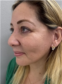 Cheek Reduction After Photo by Franklin Richards, MD; ,  - Case 50454