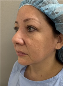 Cheek Reduction Before Photo by Franklin Richards, MD; ,  - Case 50454