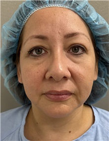 Facelift Before Photo by Franklin Richards, MD; ,  - Case 50455