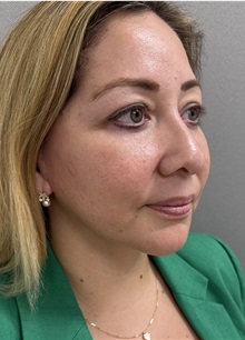 Facelift After Photo by Franklin Richards, MD; ,  - Case 50455