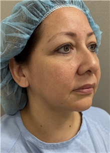 Facelift Before Photo by Franklin Richards, MD; ,  - Case 50455