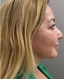 Facelift After Photo by Franklin Richards, MD; ,  - Case 50455