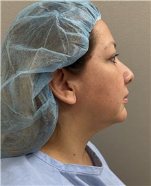 Facelift Before Photo by Franklin Richards, MD; ,  - Case 50455