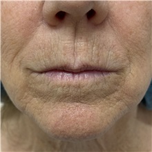 Laser Skin Resurfacing Before Photo by Franklin Richards, MD; ,  - Case 50491