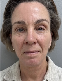Facelift After Photo by Franklin Richards, MD; ,  - Case 50642