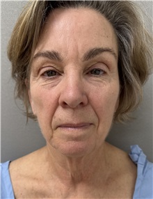 Facelift Before Photo by Franklin Richards, MD; ,  - Case 50642