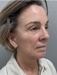 Facelift After Photo by Franklin Richards, MD; ,  - Case 50642