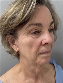 Facelift Before Photo by Franklin Richards, MD; ,  - Case 50642