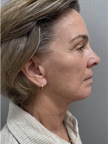 Facelift After Photo by Franklin Richards, MD; ,  - Case 50642