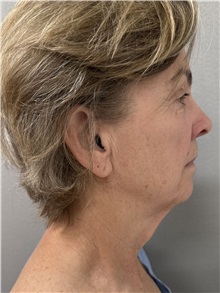 Facelift Before Photo by Franklin Richards, MD; ,  - Case 50642