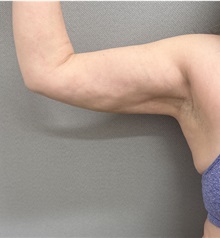 Liposuction After Photo by Franklin Richards, MD; ,  - Case 50643