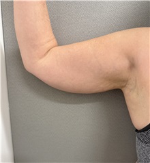 Liposuction Before Photo by Franklin Richards, MD; ,  - Case 50643