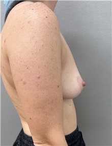 Breast Augmentation Before Photo by Franklin Richards, MD; ,  - Case 50641