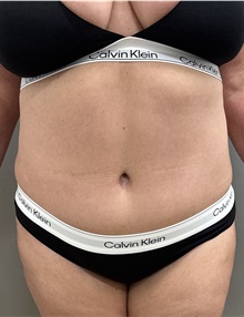 Tummy Tuck After Photo by Franklin Richards, MD; ,  - Case 50889