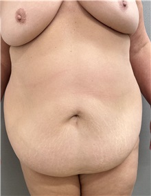 Tummy Tuck Before Photo by Franklin Richards, MD; ,  - Case 50889