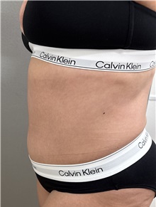 Tummy Tuck After Photo by Franklin Richards, MD; ,  - Case 50889