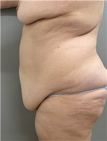 Tummy Tuck Before Photo by Franklin Richards, MD; ,  - Case 50889