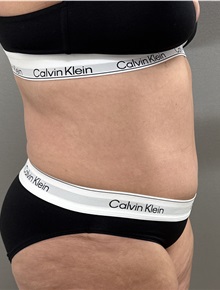 Tummy Tuck After Photo by Franklin Richards, MD; ,  - Case 50889