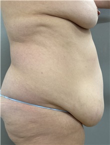 Tummy Tuck Before Photo by Franklin Richards, MD; ,  - Case 50889