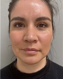 Liposuction After Photo by Franklin Richards, MD; ,  - Case 50890