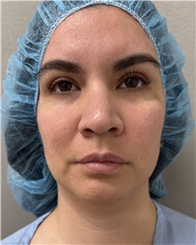 Liposuction Before Photo by Franklin Richards, MD; ,  - Case 50890