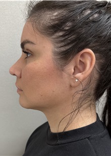 Liposuction After Photo by Franklin Richards, MD; ,  - Case 50890