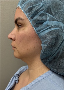 Liposuction Before Photo by Franklin Richards, MD; ,  - Case 50890