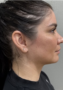 Liposuction After Photo by Franklin Richards, MD; ,  - Case 50890