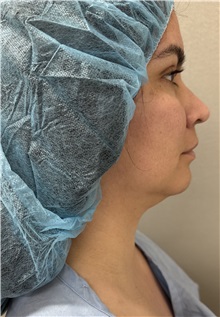 Liposuction Before Photo by Franklin Richards, MD; ,  - Case 50890