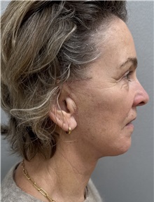 Facelift After Photo by Franklin Richards, MD; ,  - Case 50893