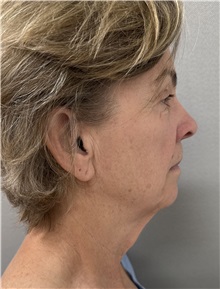 Facelift Before Photo by Franklin Richards, MD; ,  - Case 50893