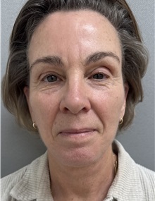 Facelift After Photo by Franklin Richards, MD; ,  - Case 50893