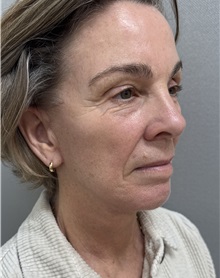 Facelift After Photo by Franklin Richards, MD; ,  - Case 50893